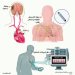 استشارات: مُسجِّل مزروع لرصد نبضات القلب - إزعاج غازات البطن