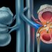 حصوات الكلى من المشكلات الصحية الشائعة (جامعة يوتا)