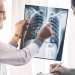سرطان الرئة من أكثر أنواع السرطان فتكاً في العالم (جامعة فلوريدا)